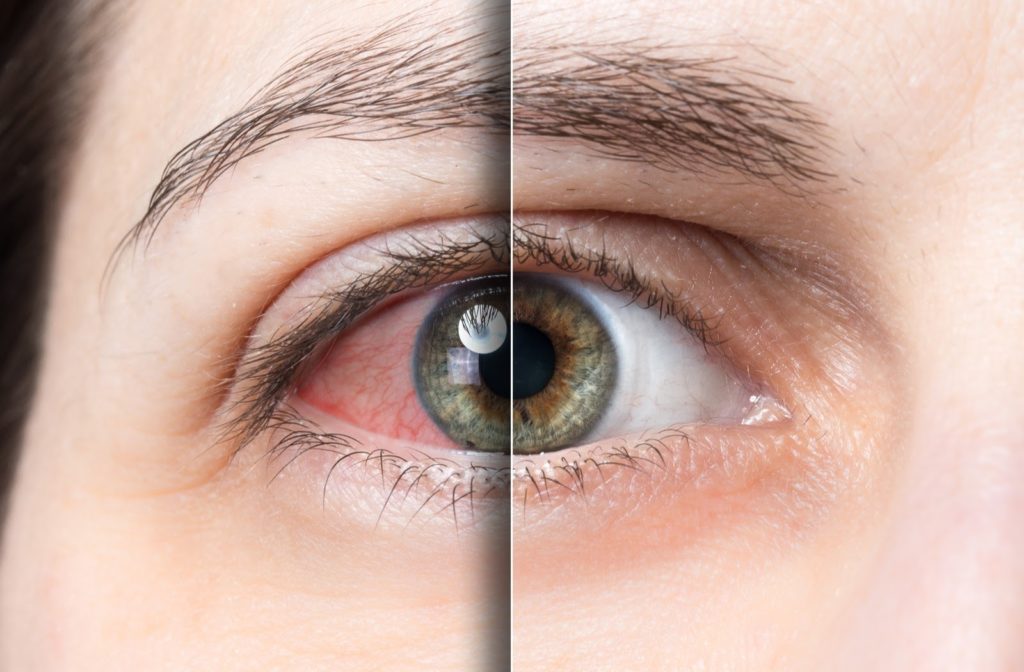 Close up of dry eye comparison on the left compared to normal eye on the right side.