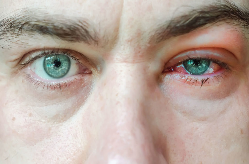 close up image of a mans face one eye is red and watery due to blepharitis