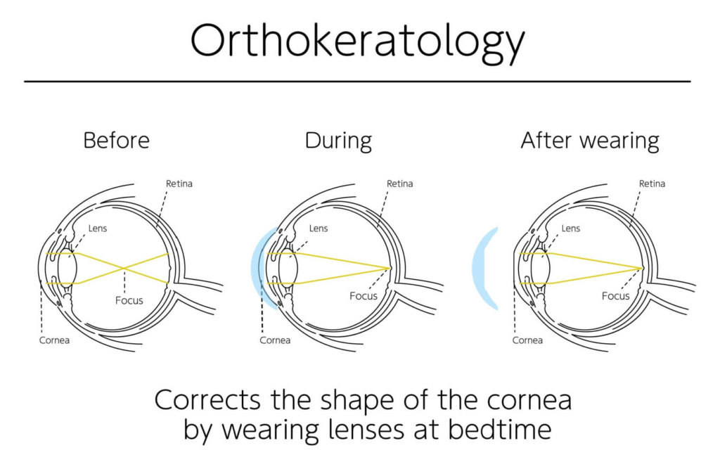 graphic depicting how ortho-k reshapes the cornea
