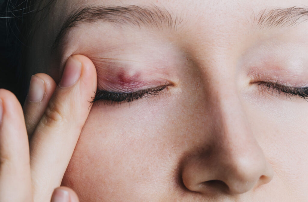 Close up image of a chalazion on a woman's right upper eyelid.