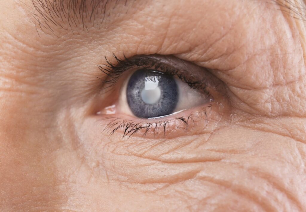 A close-up image of an eye with a cataract.