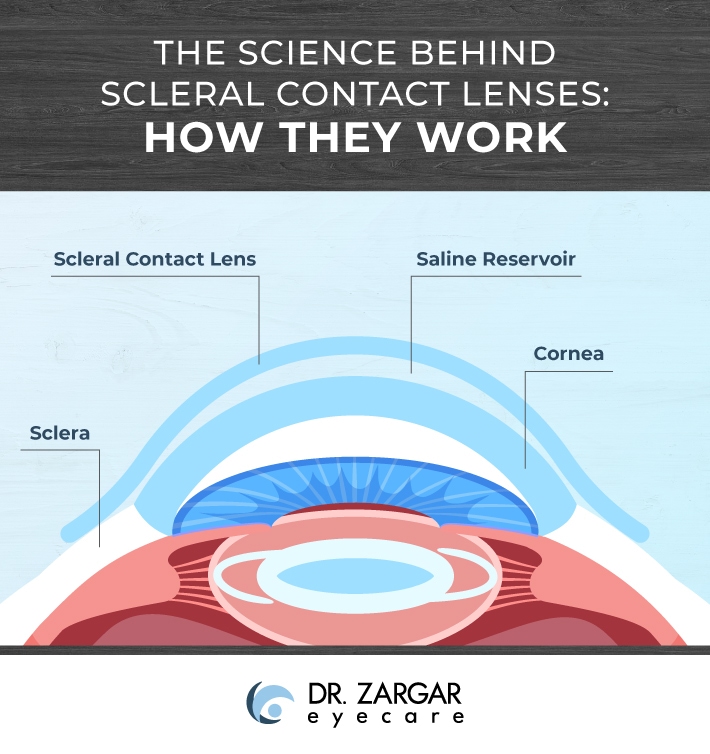 Cross-sectional diagram showing how scleral contact lenses work. The image illustrates a scleral contact lens arching over the cornea and resting on the sclera. Between the lens and the cornea is a saline reservoir that helps keep the eye hydrated and provides a smooth optical surface. Key anatomical parts labeled include the scleral contact lens, saline reservoir, cornea, and sclera. 